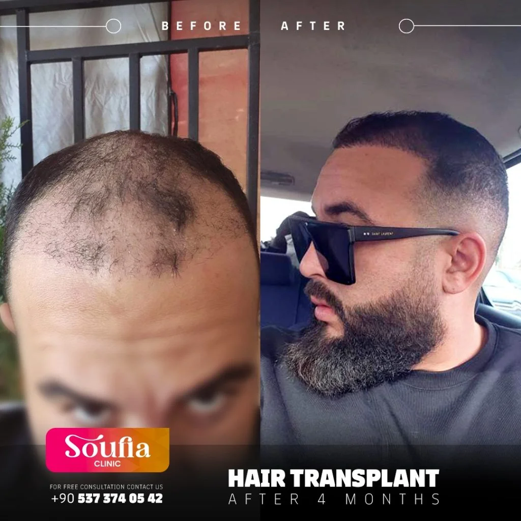 Hair Transplant — After 4 months