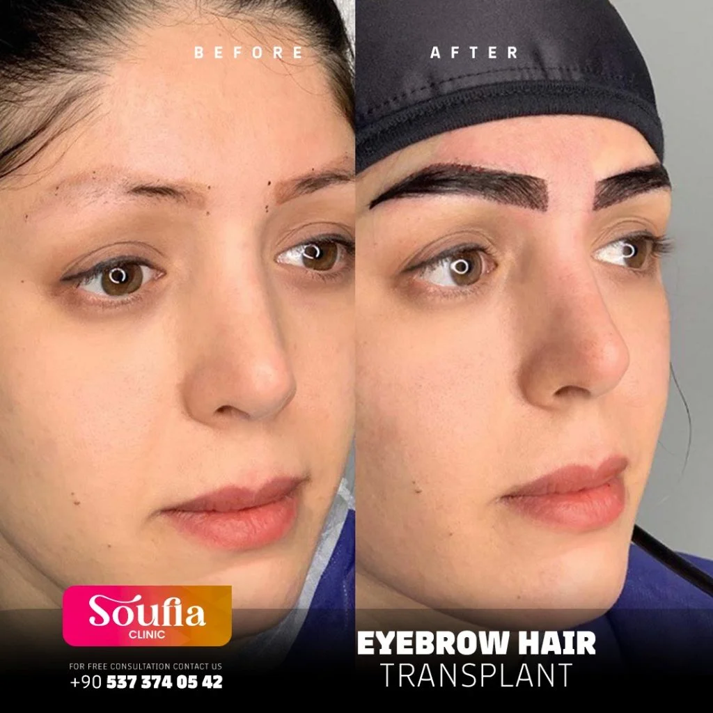 Eyebrow Hair Transplant