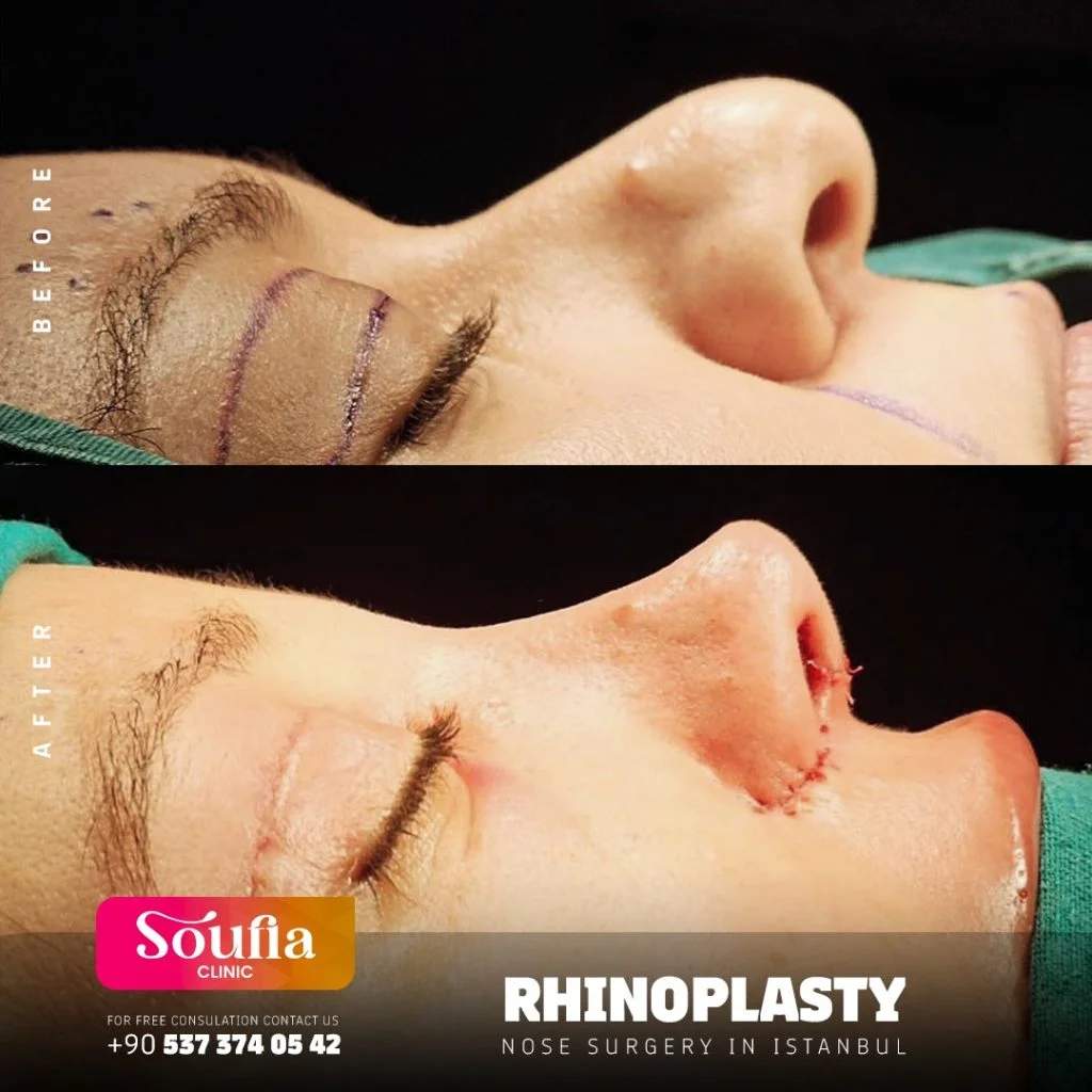 Rhinoplasty
