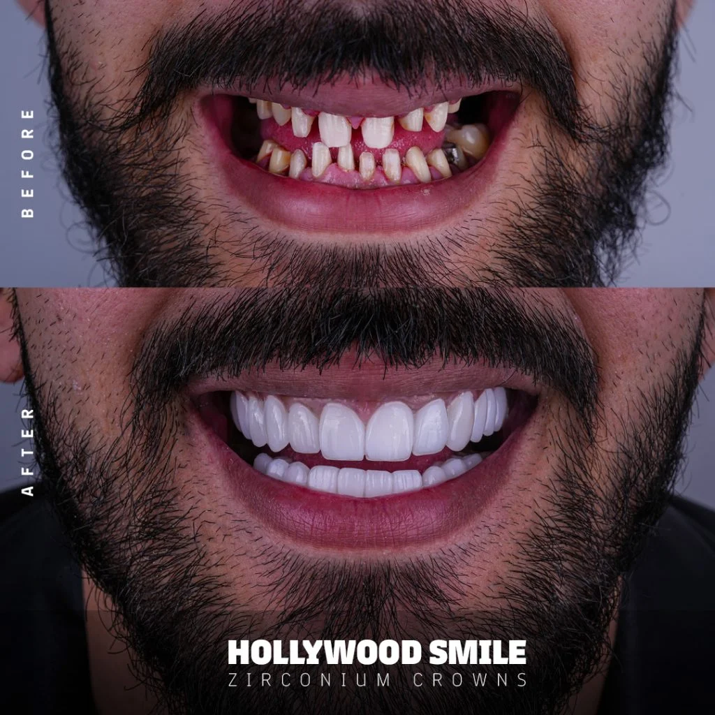 Hollywood Smile — Before & after · zirconium crowns