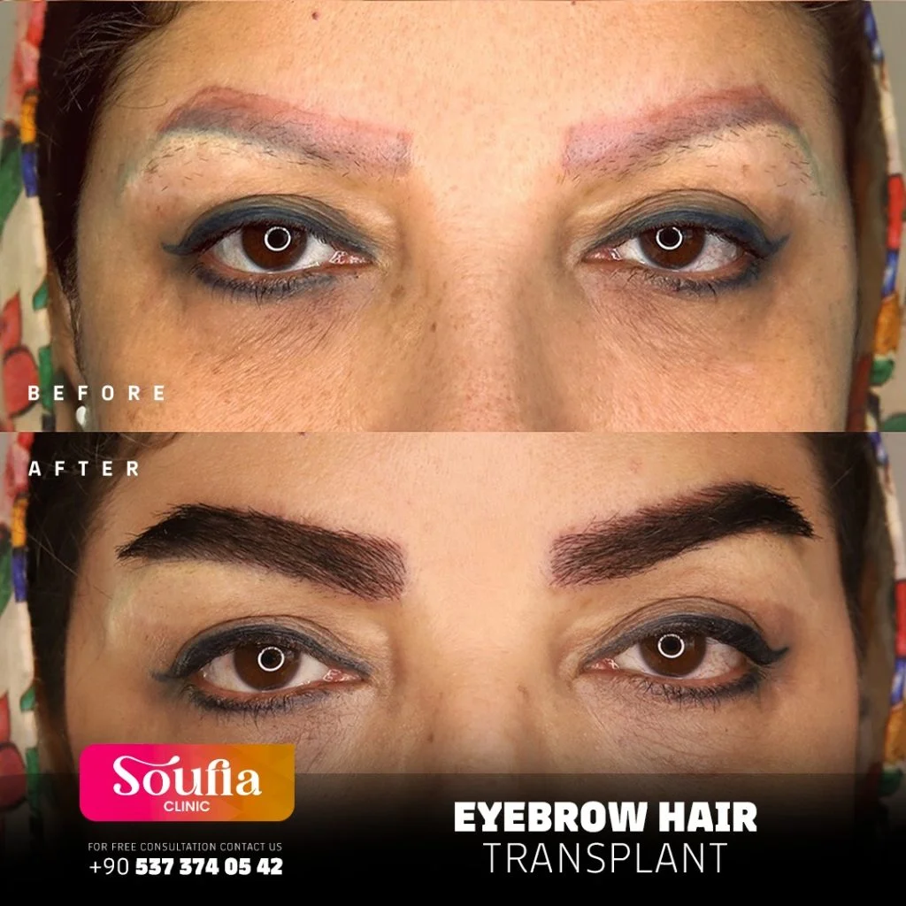 Eyebrow Hair Transplant — Before & after