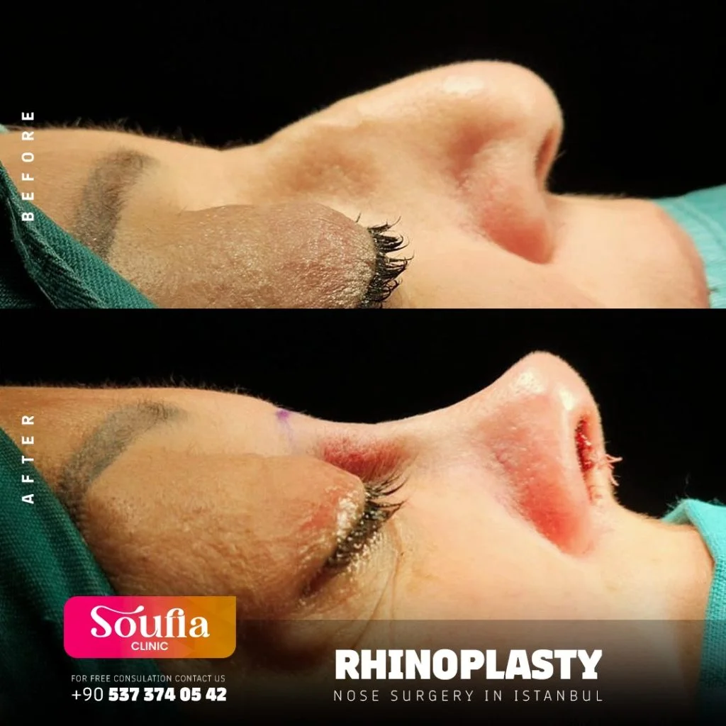 Rhinoplasty — Nose surgery in Istanbul
