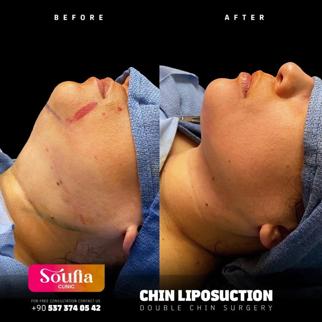 Chin Liposuction — Double chin surgery