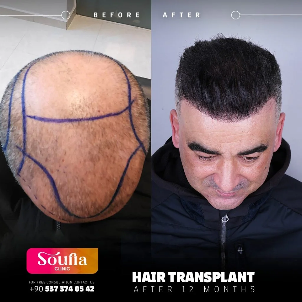 Hair Transplant