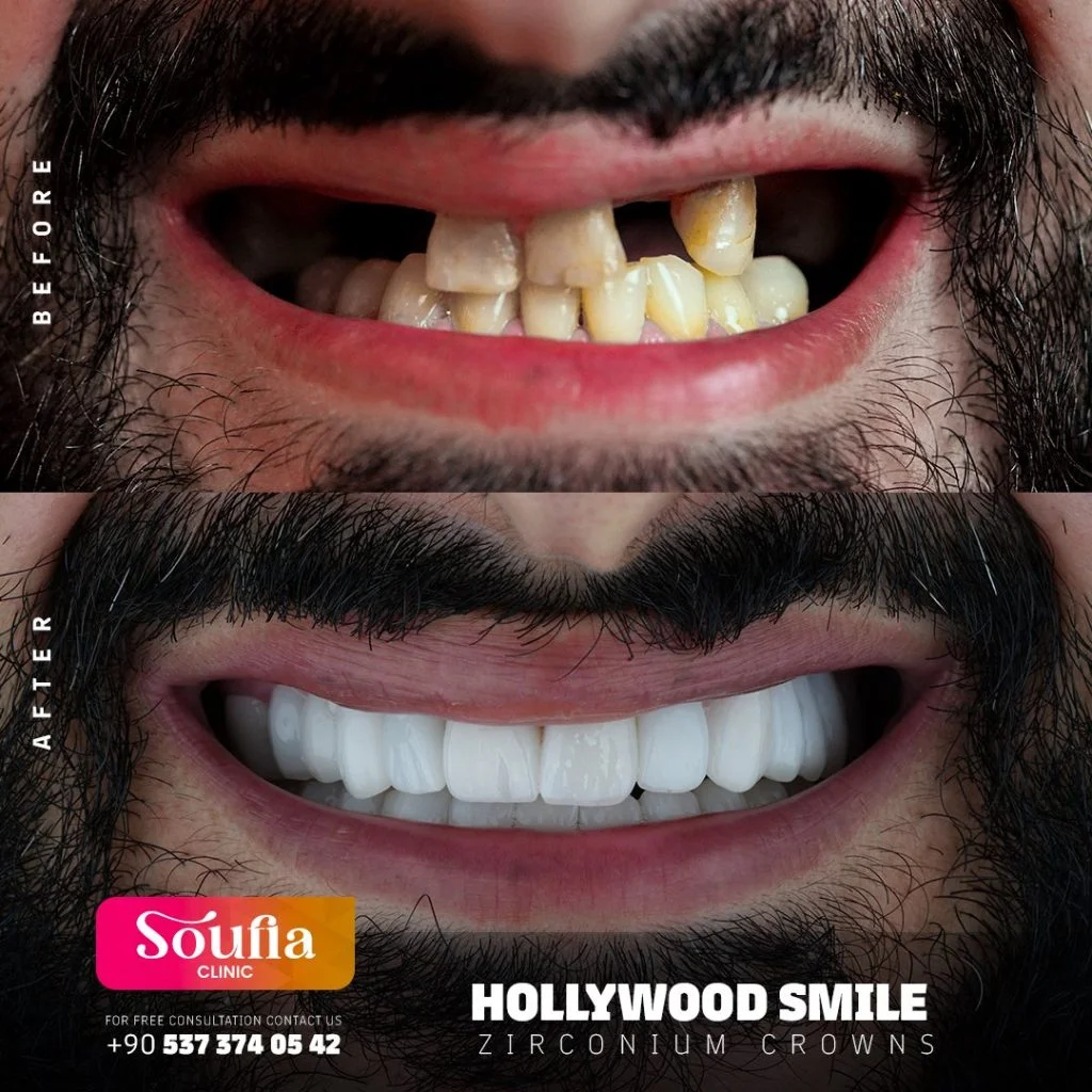 Hollywood Smile — Before & after · zirconium crowns