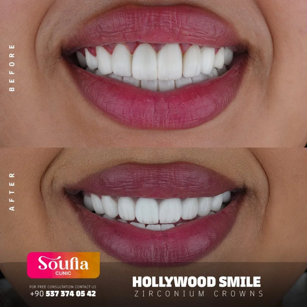 Hollywood Smile — Before & after · zirconium crowns