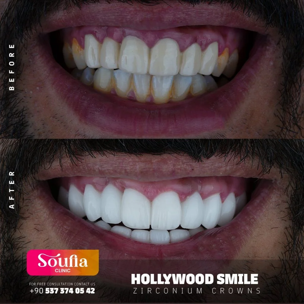 Hollywood Smile