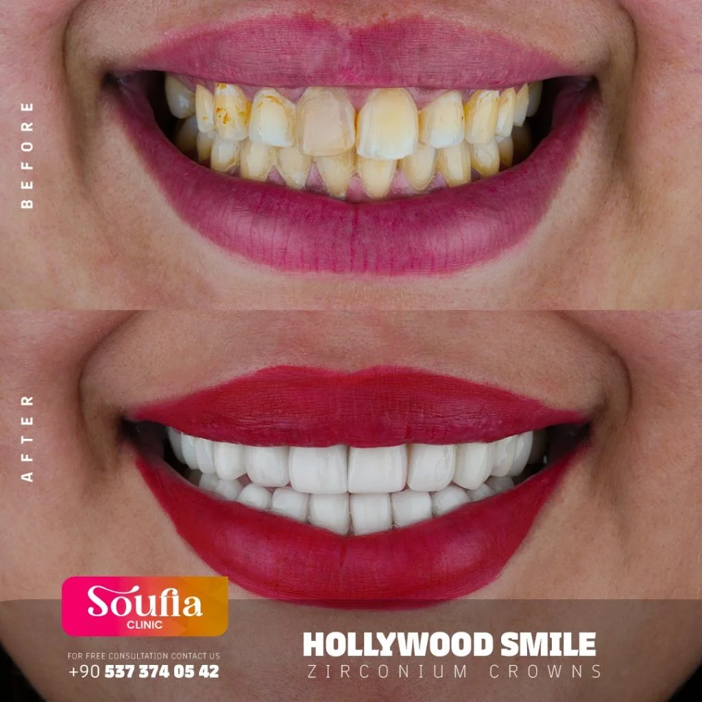 Hollywood Smile — Before & after · zirconium crowns