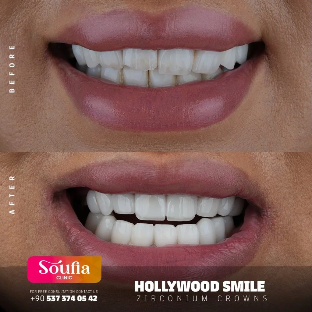 Hollywood Smile — Before & after · zirconium crowns